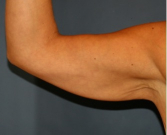 Feel Beautiful - Arm Reduction 205 - Before Photo